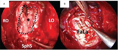 Interdisciplinary challenges and aims of flap or graft reconstruction surgery of sinonasal cancers: What radiologists and radiation oncologists need to know